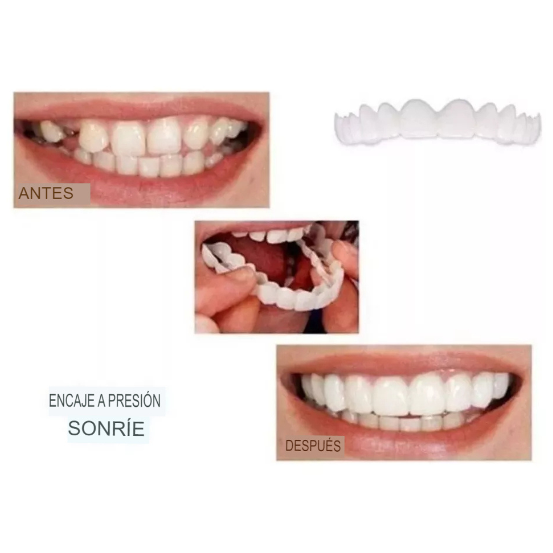 Carillas Dentales Snap-on Smile