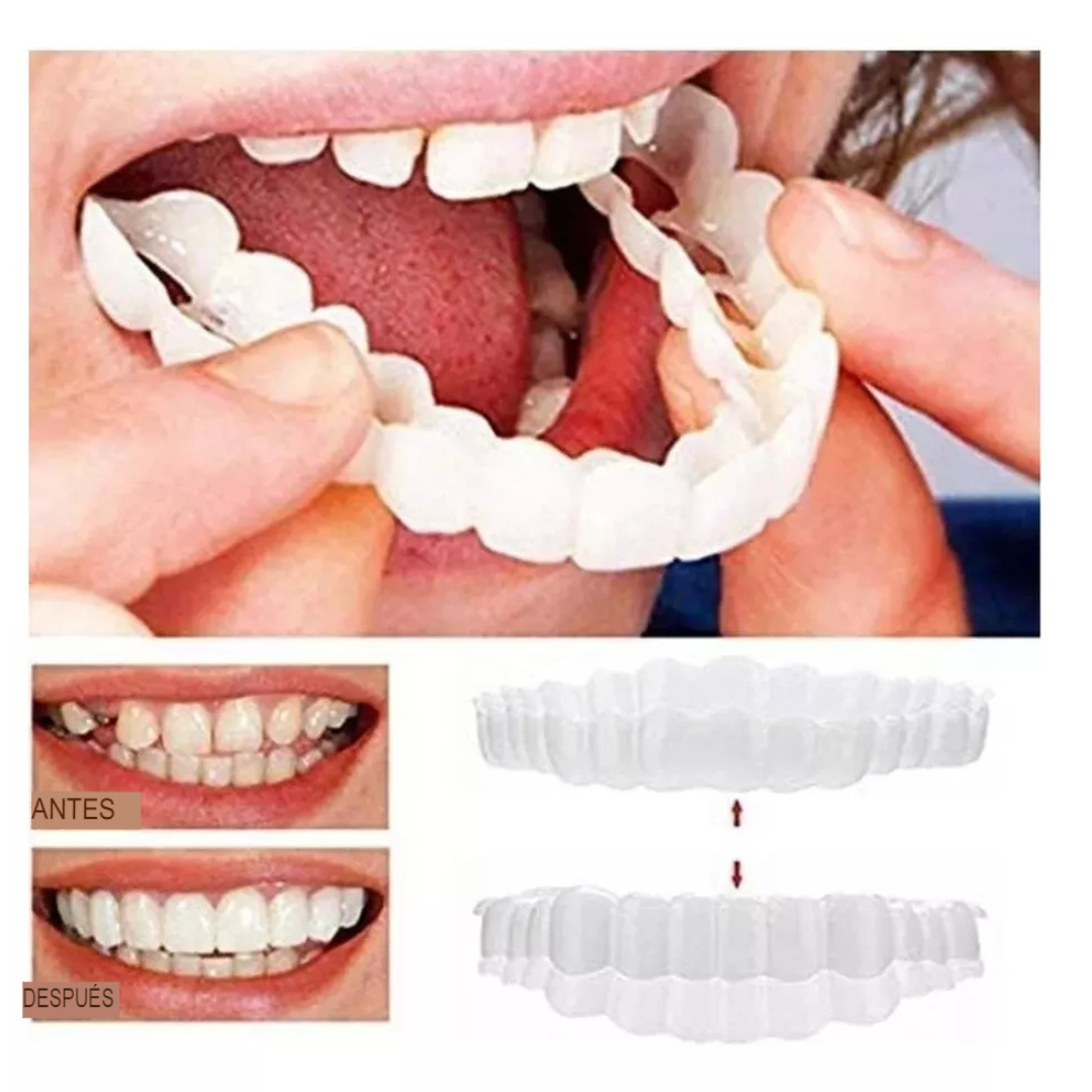 Carillas Dentales Snap-on Smile