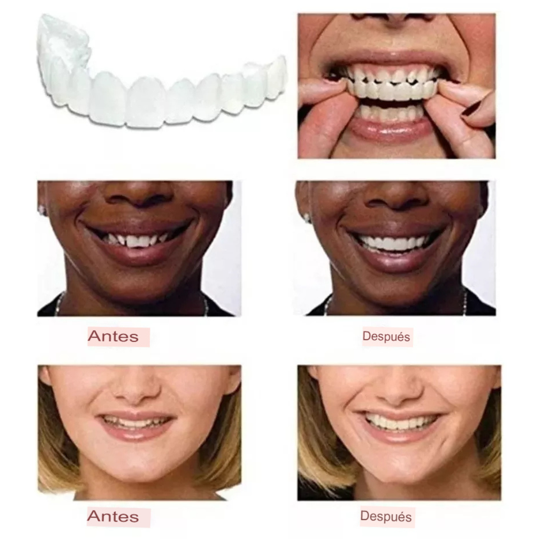 Carillas Dentales Snap-on Smile